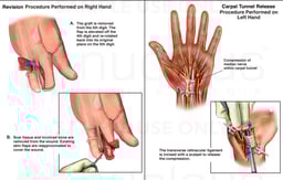 Revision of Fourth Finger Amputation and Surgical Carpal Tunnel Release