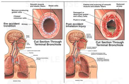Severe Inhalation Injury Due to Chemical or Smoke Exposure