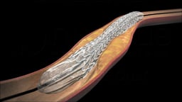 Non-cardiac Percutaneous Transluminal Angioplasty (NCPTA)