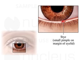 Stye