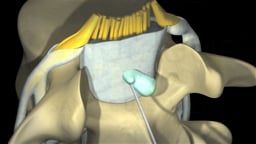 Epidural Steroid Injection