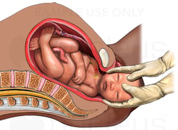 Vaginal Delivery with Brachial Plexus Nerve Injury (Shoulder Dystocia)