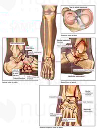 Post-accident Right Knee, Ankle and Foot Injuries