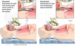 Correct (Endotracheal) vs. Incorrect (Esophageal) Intubation