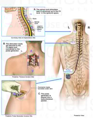 Implantation of Spinal Cord Stimulator and Pulse Generator