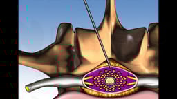 Subdural versus Epidural Spinal Injection