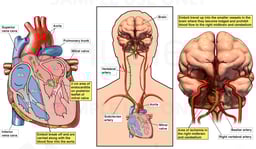 Mitral Valve Endocarditis with Resulting Cerebral Embolus