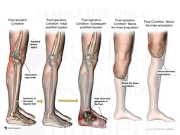 Progression of Right Leg Injury and Surgeries