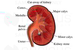 Kidney Stone