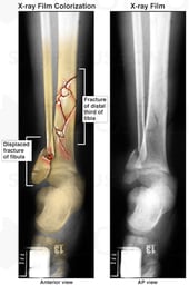 Fracture of Distal Third of Tibia