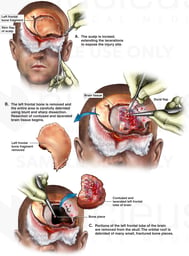 Brain Surgery - Partial Left Frontal Lobectomy