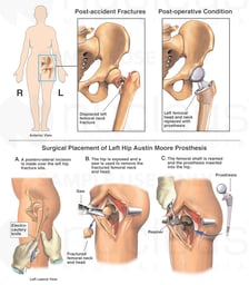 Hip Injury - Fractured Femoral Neck with Prosthetic Replacement Surgery