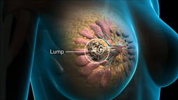 Breast Anatomy with Internal Lump Labeled