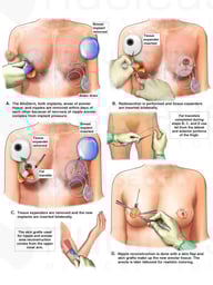 Subsequent Breast Reconstruction Surgeries
