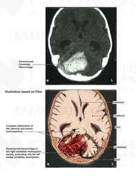 Fetal Brain Injury