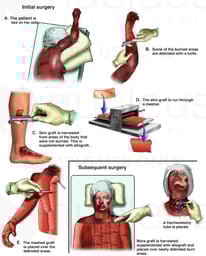 Multiple Debridement and Skin Grafting Procedures