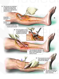 Multiple Debridement Procedures