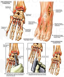 Foot Crush Fractures - Open Reduction and Fixation