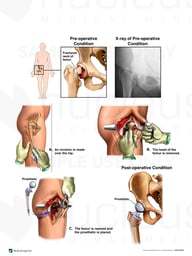 Right Femoral Neck Fracture with Surgical Hip Replacement