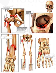 Orthopedic Injures to the Right Hip, Orbit, Lower leg and Left Foot