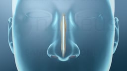 Nasal Septoplasty