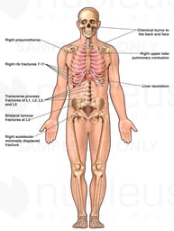 Anterior Male Skeletal and Thoracic Figure for Injury Location