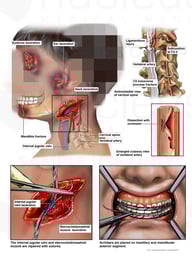 Left Head and Neck Injuries with Surgical Repairs