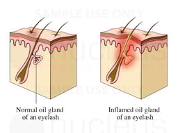 Sty: Sebaceous Glands of the Eyelid