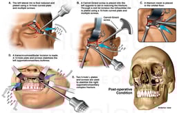 Open Reduction and Internal Fixation of the Skull Fractures