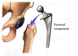Total Hip Replacement-Femoral Component