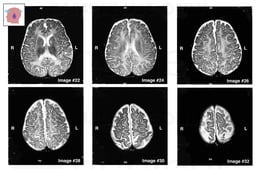 Axial MRI Views of the Brain