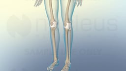 Osteoarthritis vs. Rheumatoid Arthritis