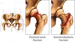 Femoral Neck Fracture and Intertrochanteric Fracture
