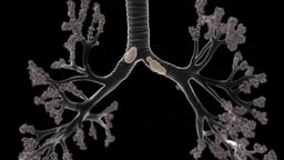 Mucus Accumulation in Bronchi