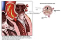 Abnormal Aortic Valve Regurgitation