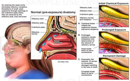 Olfactory Nerve Damage