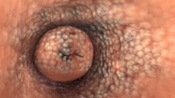 Cervical Cancer Progression and Staging