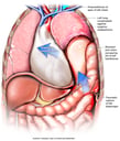 Traumatic Rupture of Diaphragm with Massive Displacement of Chest and Abdominal Organs