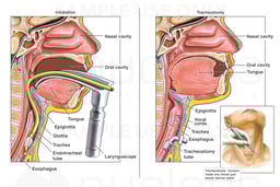 Classic Intubation and Tracheostomy Procedures