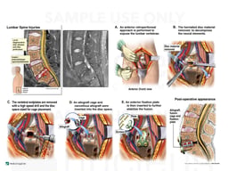 Lumbar Spine Injury with Anterior Discectomy and Fusion