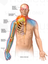 Nerve Damage Affecting Right Hand and Arm