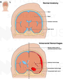 Comparison of Normal Anatomy with Intracranial Hemorrhages