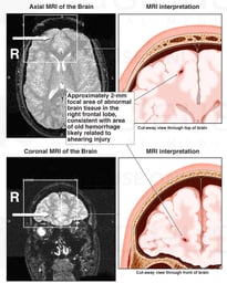 Right Frontal Brain Injury