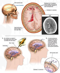 Traumatic Brain Injury with Surgical Ventriculostomy