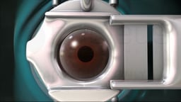 Eye with Ring and Microkeratome in LASIK Procedure