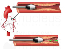 Removal of Plaque in Coronary Artery