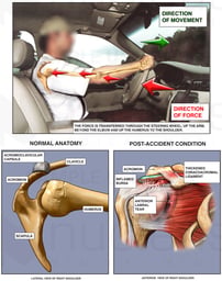 Mechanism of Shoulder Injury In Motor Vehicle Accident (MVA)