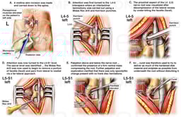 Left L4-5 Laminotomy and Far-lateral L5-S1Approach for L5 Nerve Root Decompression