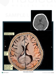 CT Evidence of Right Middle Cerebral Artery Cerebrovascular Accident