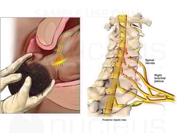 Avulsion of the Spinal Nerves Supplying the Brachial Plexus
